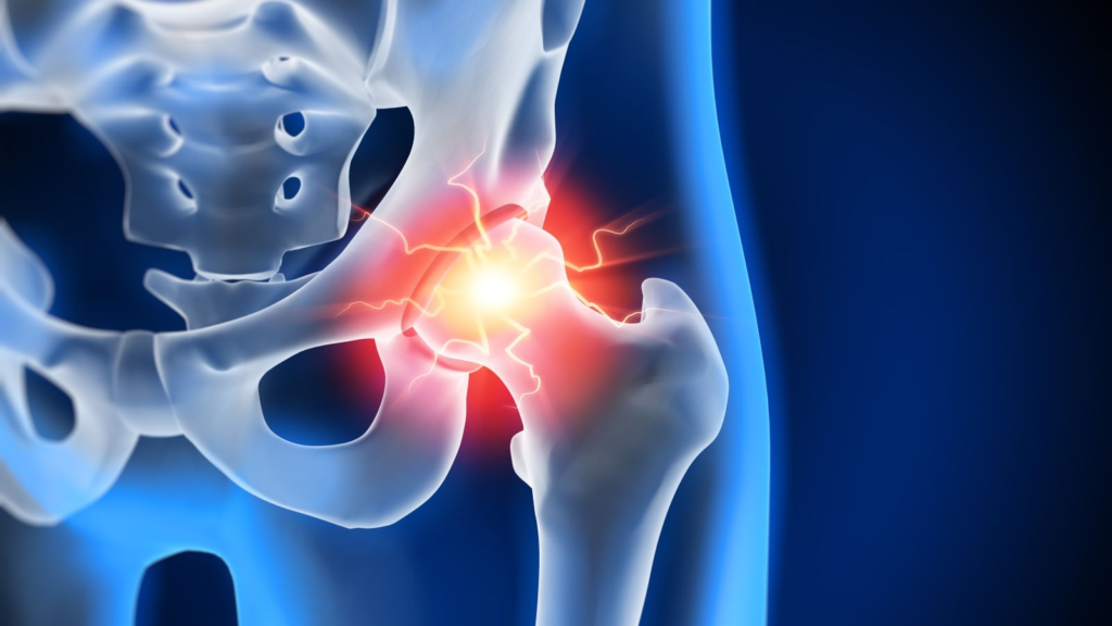 Unlocking the Deep Squat: Navigating Cam and Pincer Hip Impingement in Field Sports and Lifting