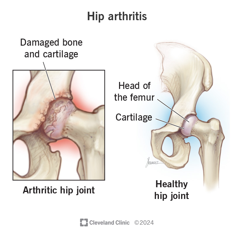 Hip Osteoarthritis: Managing Joint Stiffness & Preserving Range of Motion Without Rushing to Surgery